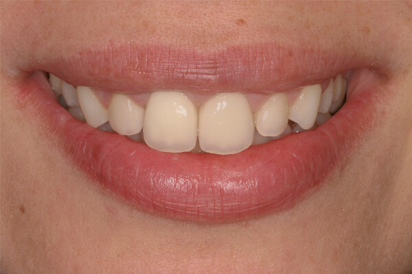 Reabilitação com implantes e coroas em cerâmica