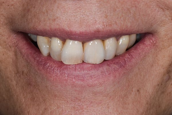 Tratamento das Gengivas e incisivos central e lateral esquerdo