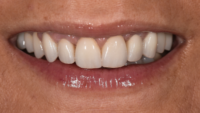 Caso Clínico assimétrico e bem integrado em especialidade de medicina dentária