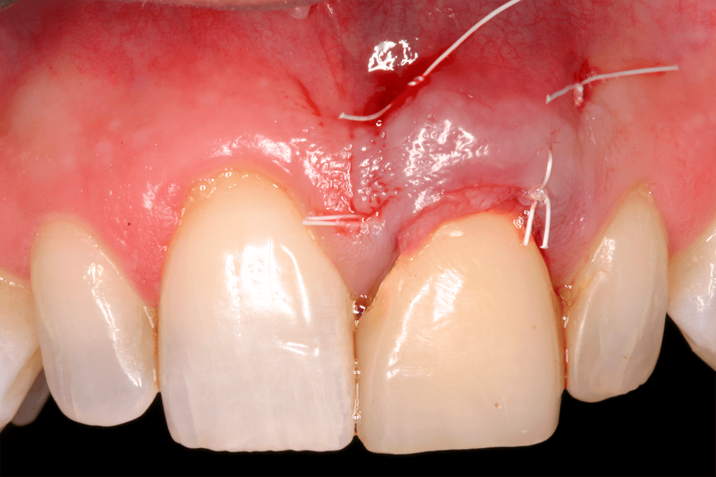 Clinica Pinheiro Torres - Gingival Transparency due to Inadaptation of Metalo-Ceramic Crown