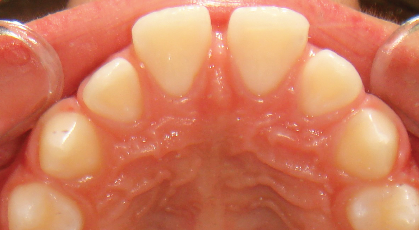 Ortodontia - Avanço da dentição superior