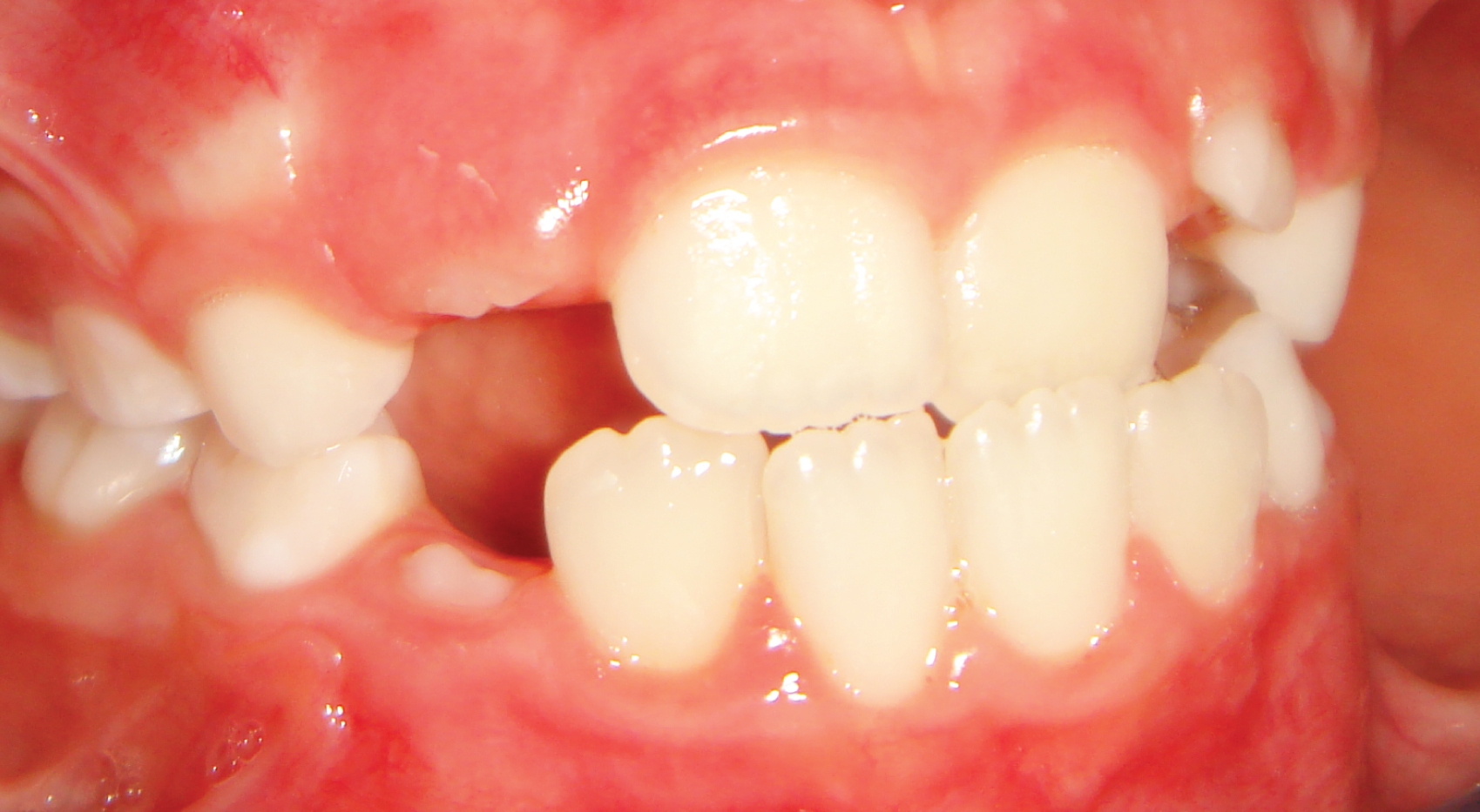 Ortodontia - Dentição superior recuada em relação à inferior