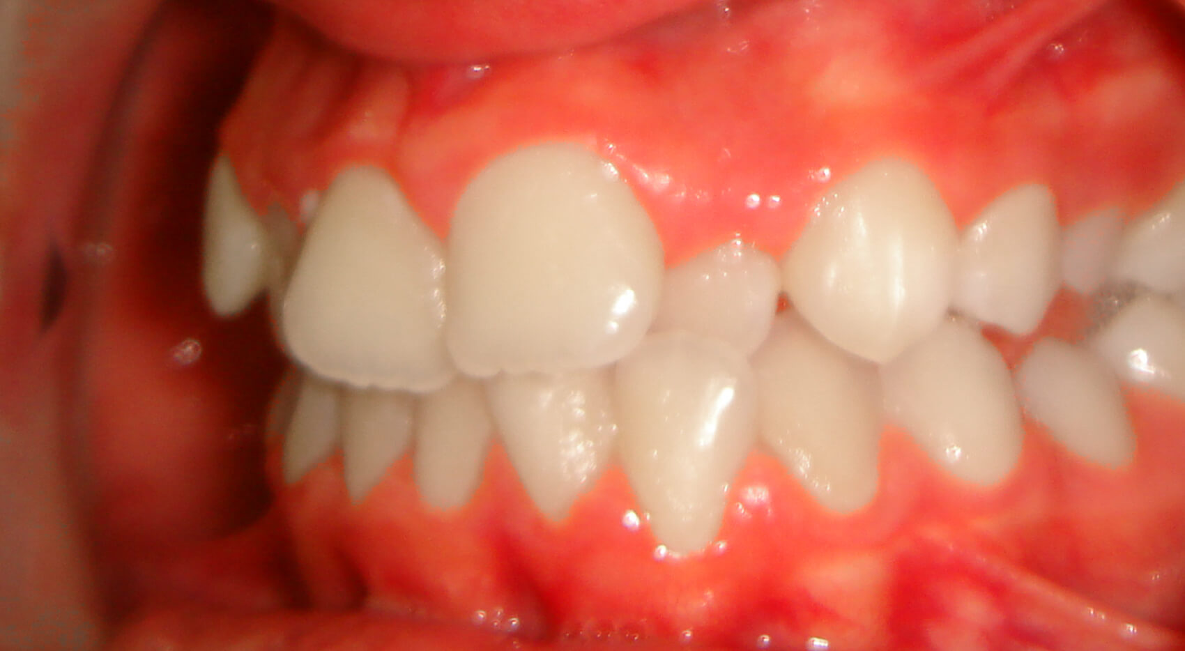 Ortodontia - Apinhamento moderado_GG_4