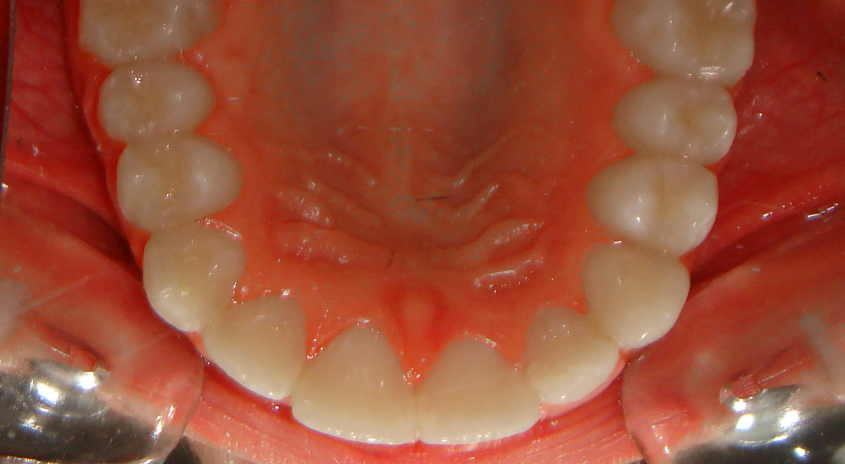 Ortodontia - Apinhamento moderado