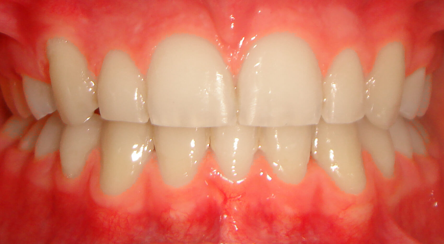 Ortodontia - Sobremordida, retroinclinação
